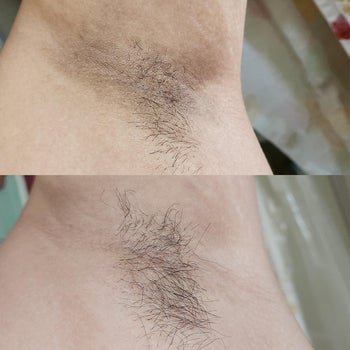 a reviewer's before and after of their arm pits after using kojic acid soap